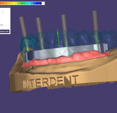 EXOCAD – Gred na implantatih