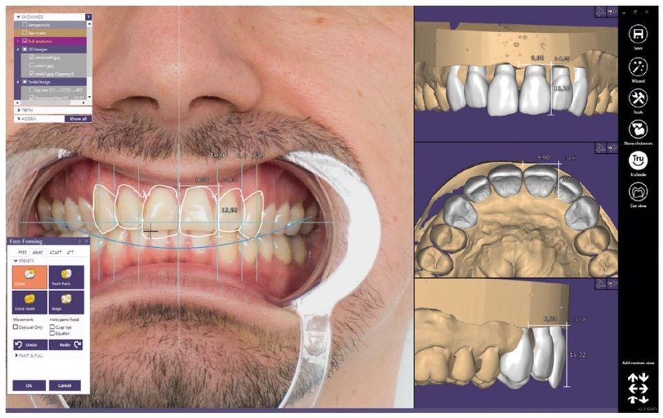 EXOCAD – Smile Creator