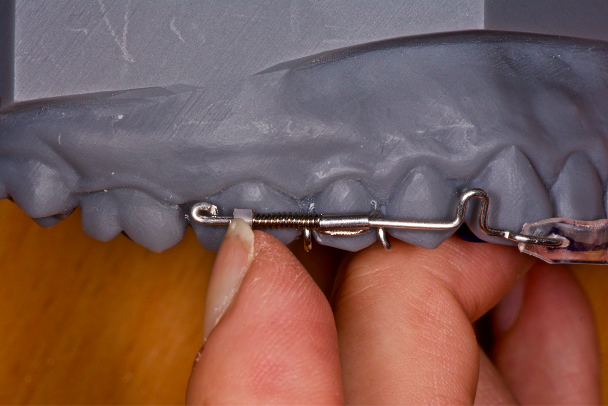 IAS Academy - ClearSmile Aligner Light in Inman Aligner