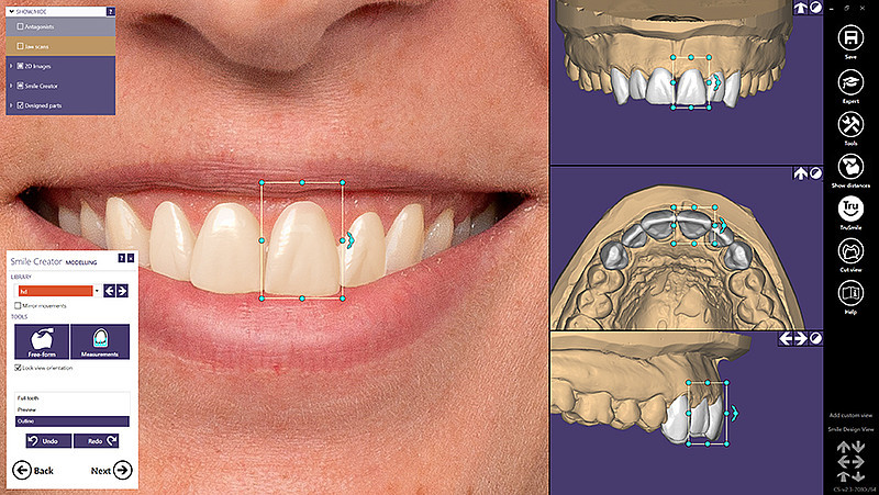 EXOCAD – Smile Creator